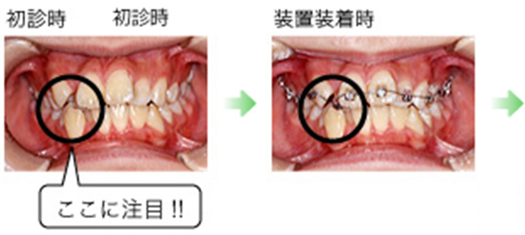 症例1：初診時は上の歯と下の歯がずれています