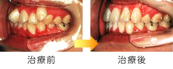 写真：そう生（乱ぐい歯・八重歯）の治療例