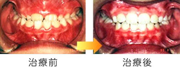 写真：下顎前突（受け口）の治療例