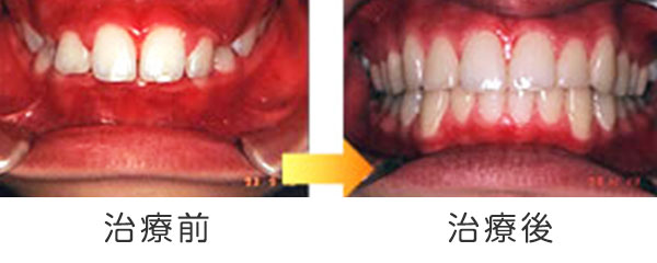 写真：上顎前突（出っ歯）の治療例