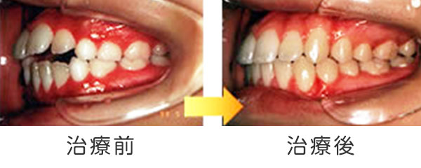 写真：開咬の治療例